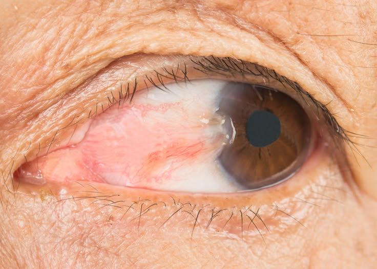 Pterygium on the surface of the eye